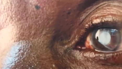 Wagonjwa 500 Kurejeshewa Uwezo wa Kuona Songwe